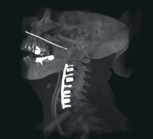 cervicalspine