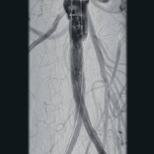 ci-abdominalaorticaneurysm-ziehmvisionrfd-cmosline