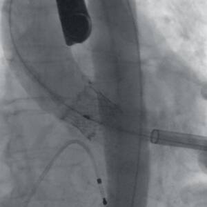 ci-aorticarch-ziehmvisionrfd-cmosline