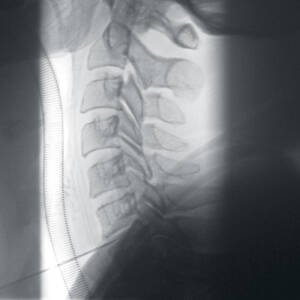ci-cervicalspine-ziehmsolofd