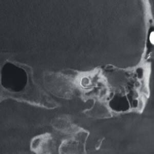 ci-cochlearimplant-ziehmvisionrfd3d-cmosline
