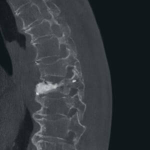 ci-kyphoplastysurgery-ziehmvisionrfd3d-cmosline