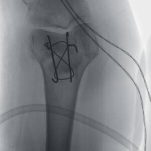 ci-patellafracture-ziehmvisionrfd-cmosline