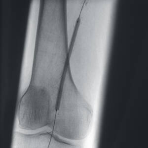 ci-peripheralrevascularization-ziehmsolofd