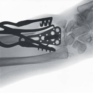 ci-stabilizationofradiusfracture-ziehmsolofd