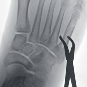 ci-toefracture_magmode0_ziehmsolofd