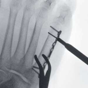 ci-toefracture_magmode1_ziehmsolofd