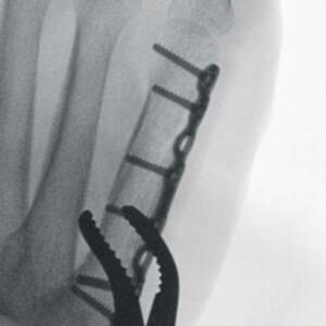 ci-toefracture_magmode2_ziehmsolofd