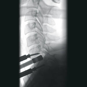 ci_cervicalspine_ziehmvisionfd_cmos