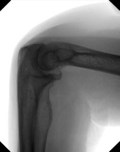 mobile-di-clinical-image-elbow-lateral_web