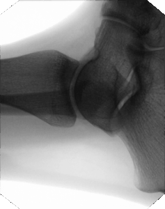 tau_1512_x-ray_ankle_lateral_900px
