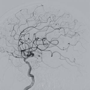 zie-3074-x-ray-00001290_pvdr_ii_srgb_forscreensonly