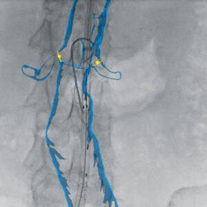 zie-3080-x-ray-00001149_pvdr2_ii_srgb_forscreensonly