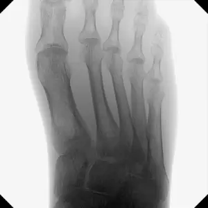 versa-clinical-image-ankle-ap_web.1600x0
