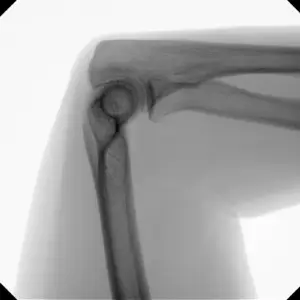 versa-clinical-image-elbow-lateral_web_1.1600x0